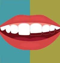 Sonrisa con dientes con y sin desgaste