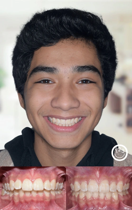 Fotografía de antes y después de un tratamiento de ortodoncia realizado en Sonríe 123 en un adolescente.