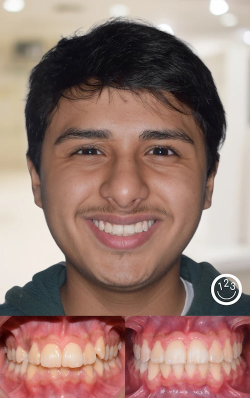 Fotografía de antes y después de un tratamiento de ortodoncia realizado en Sonríe 123 en un adolescente.