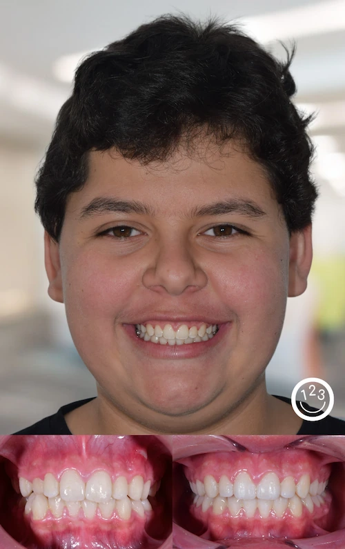 Fotografía de antes y después de un tratamiento de ortodoncia realizado en Sonríe 123 en un adolescente.
