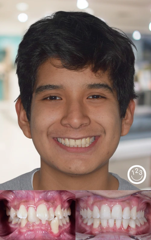 Fotografía de antes y después de un tratamiento de ortodoncia realizado en Sonríe 123 en un adolescente.