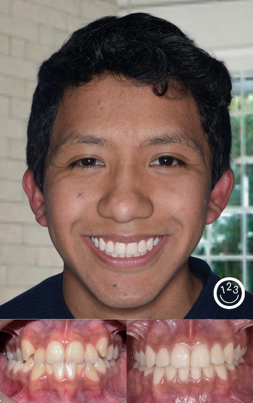 Fotografía de antes y después de un tratamiento de ortodoncia realizado en Sonríe 123 en un adolescente.