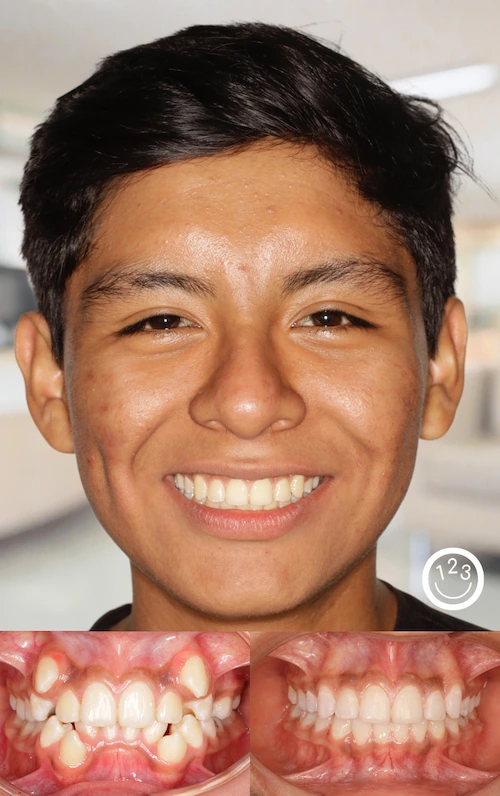 Fotografía de antes y después de un tratamiento de ortodoncia realizado en Sonríe 123 en un adolescente.
