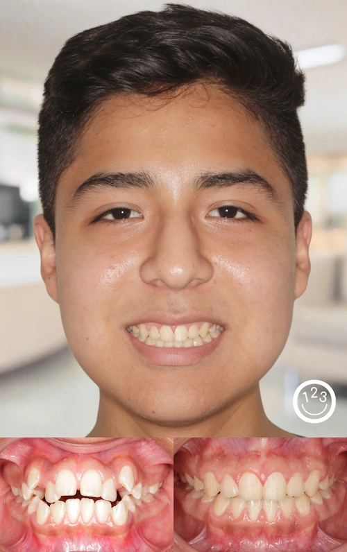 Fotografía de antes y después de un tratamiento de ortodoncia realizado en Sonríe 123 en un adolescente.