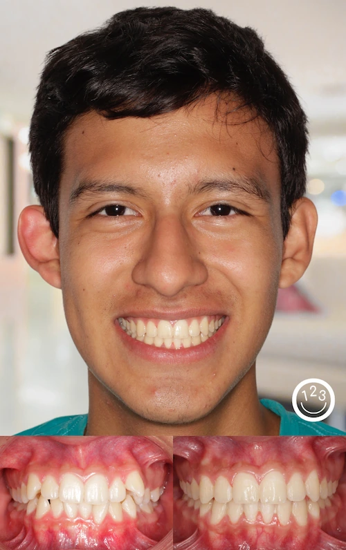 Fotografía de antes y después de un tratamiento de ortodoncia realizado en Sonríe 123 en un adolescente.