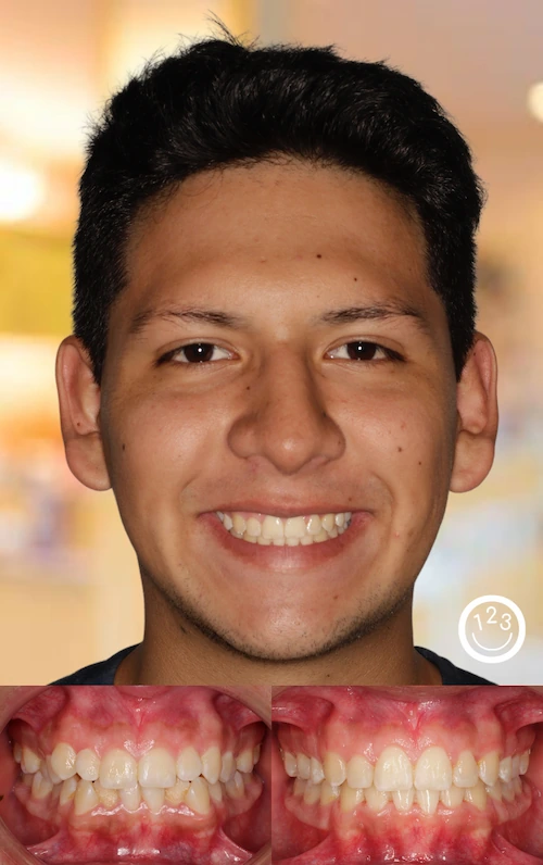 Fotografía de antes y después de un tratamiento de ortodoncia realizado en Sonríe 123 en un adolescente.