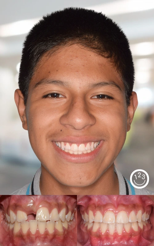 Fotografía de antes y después de un tratamiento de ortodoncia realizado en Sonríe 123 en un adolescente.