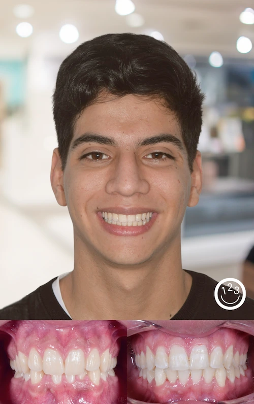 Fotografía de antes y después de un tratamiento de ortodoncia realizado en Sonríe 123 en un adolescente.