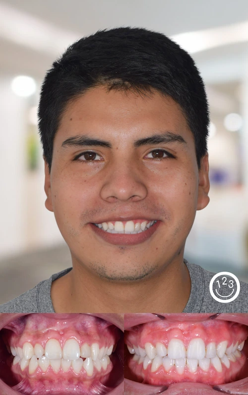 Fotografía de antes y después de un tratamiento de ortodoncia realizado en Sonríe 123 en un adolescente.