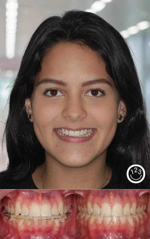 Fotografía de antes y después de un tratamiento de ortodoncia realizado en Sonríe 123 en un adolescente.