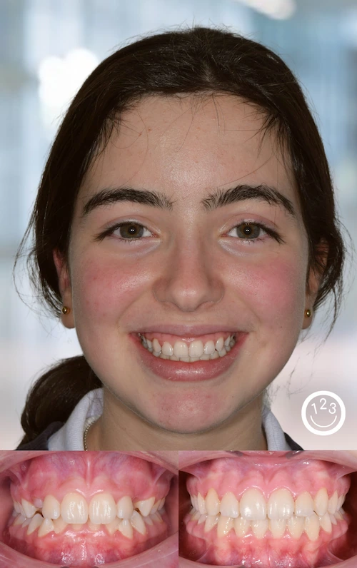 Fotografía de antes y después de un tratamiento de ortodoncia realizado en Sonríe 123 en un adolescente.
