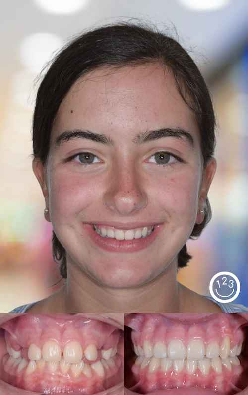 Fotografía de antes y después de un tratamiento de ortodoncia realizado en Sonríe 123 en un adolescente.