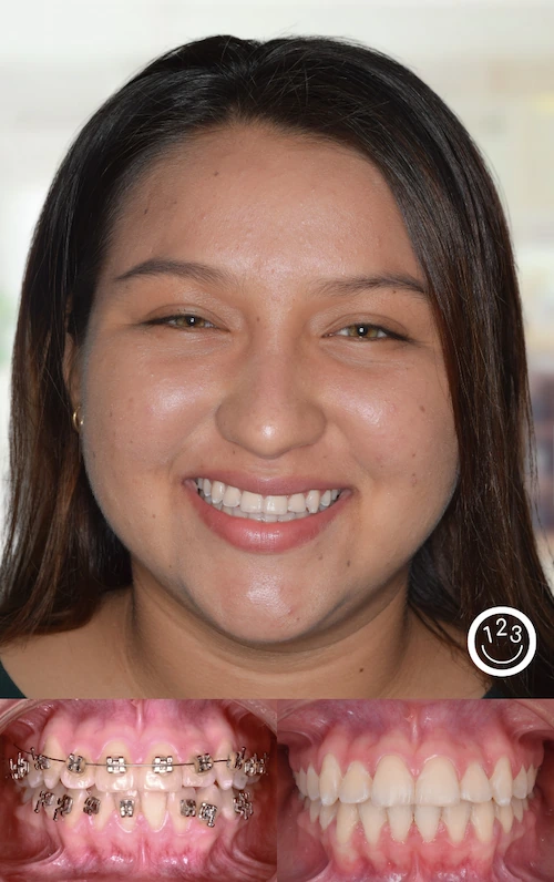 Fotografía de antes y después de un tratamiento de ortodoncia realizado en Sonríe 123 en un adolescente.