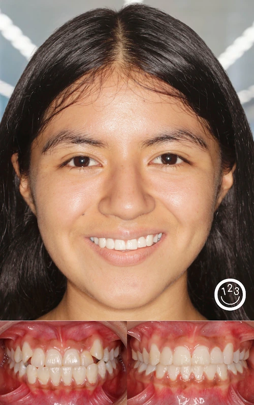 Fotografía de antes y después de un tratamiento de ortodoncia realizado en Sonríe 123 en un adolescente.