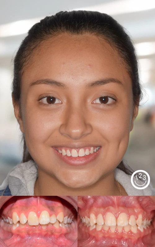Fotografía de antes y después de un tratamiento de ortodoncia realizado en Sonríe 123 en un adolescente.