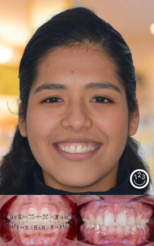 Fotografía de antes y después de un tratamiento de ortodoncia realizado en Sonríe 123 en un adolescente.