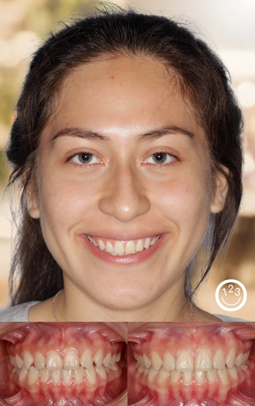 Fotografía de antes y después de un tratamiento de ortodoncia realizado en Sonríe 123 en un adulto.