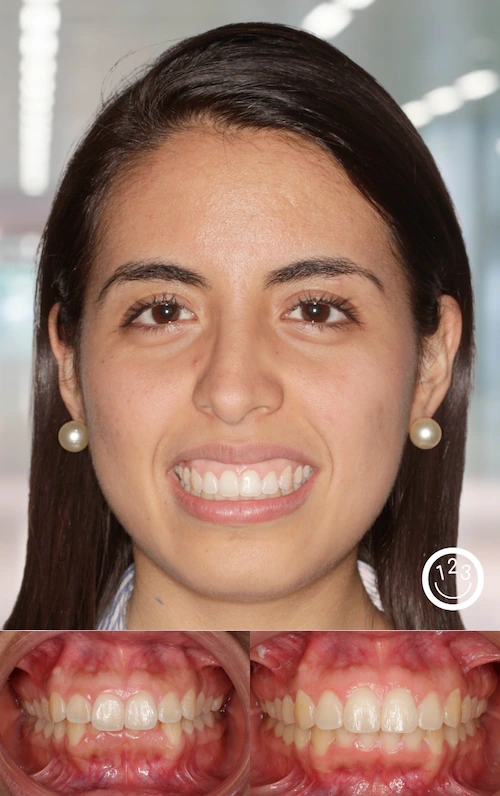 Fotografía de antes y después de un tratamiento de ortodoncia realizado en Sonríe 123 en un adulto.