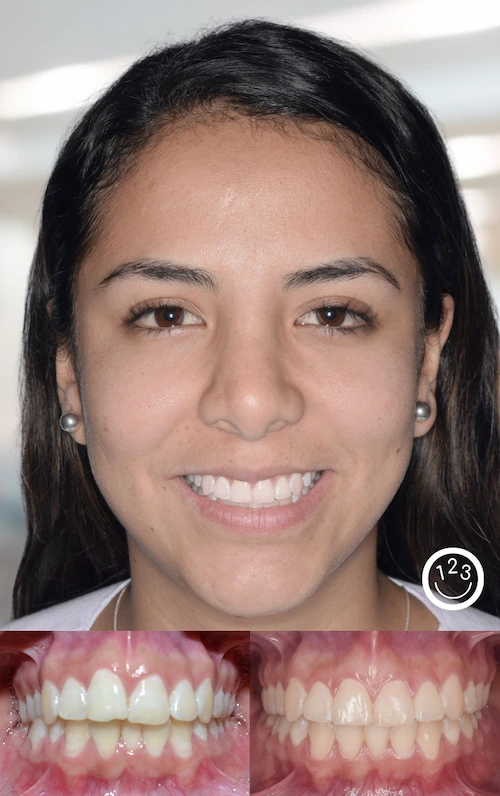 Fotografía de antes y después de un tratamiento de ortodoncia realizado en Sonríe 123 en un adulto.
