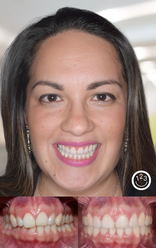 Fotografía de antes y después de un tratamiento de ortodoncia realizado en Sonríe 123 en un adulto.