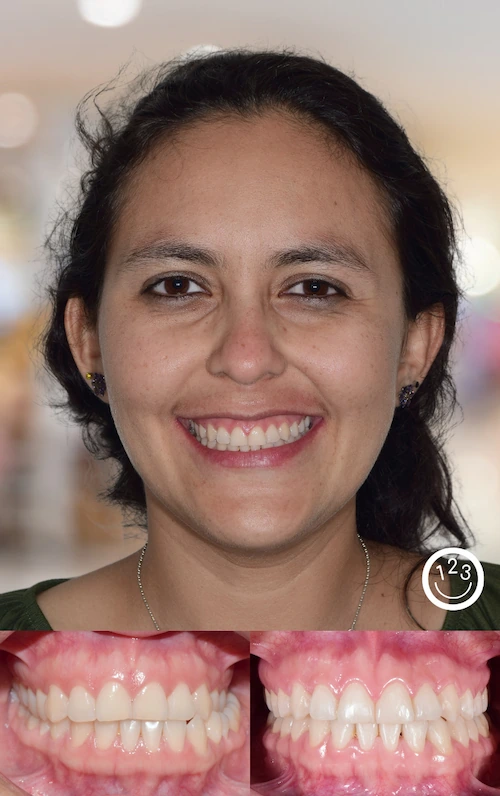 Fotografía de antes y después de un tratamiento de ortodoncia realizado en Sonríe 123 en un adulto.