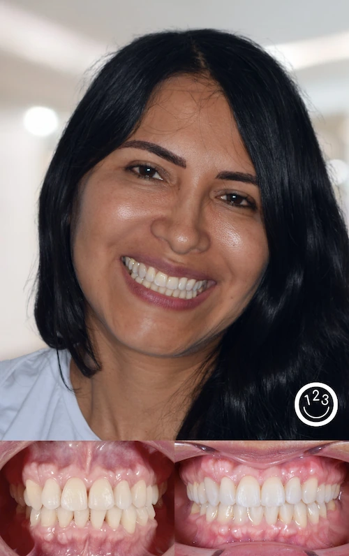 Fotografía de antes y después de un tratamiento de ortodoncia realizado en Sonríe 123 en un adulto.