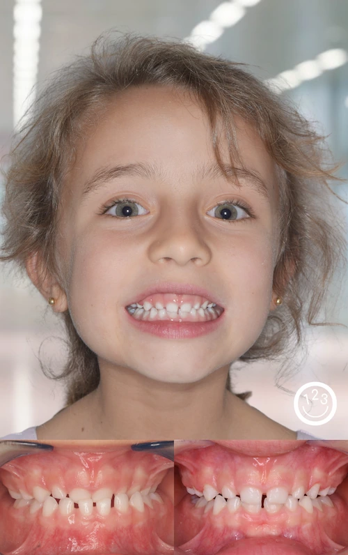 Fotografía de antes y después de un tratamiento de ortodoncia realizado en Sonríe 123 en un niña.