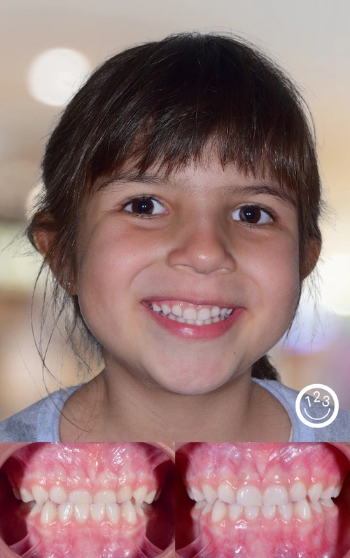 Fotografía de antes y después de un tratamiento de ortodoncia realizado en Sonríe 123 en un niña.