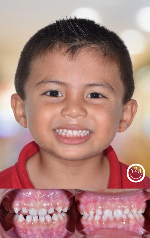 Fotografía de antes y después de un tratamiento de ortodoncia realizado en Sonríe 123 en un niño.